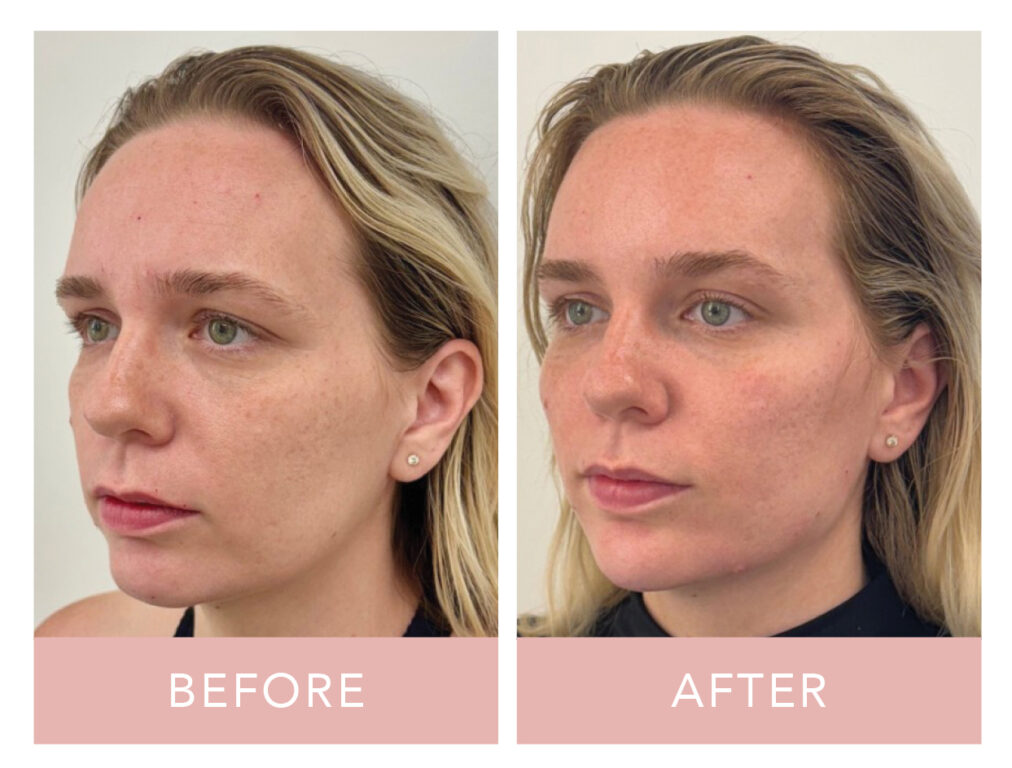 Liquid Facelift before and after