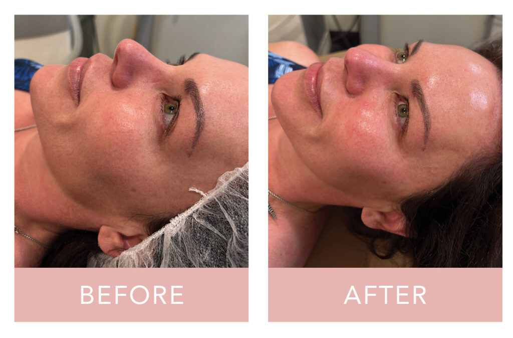 PRX-T33 Peel before and after
