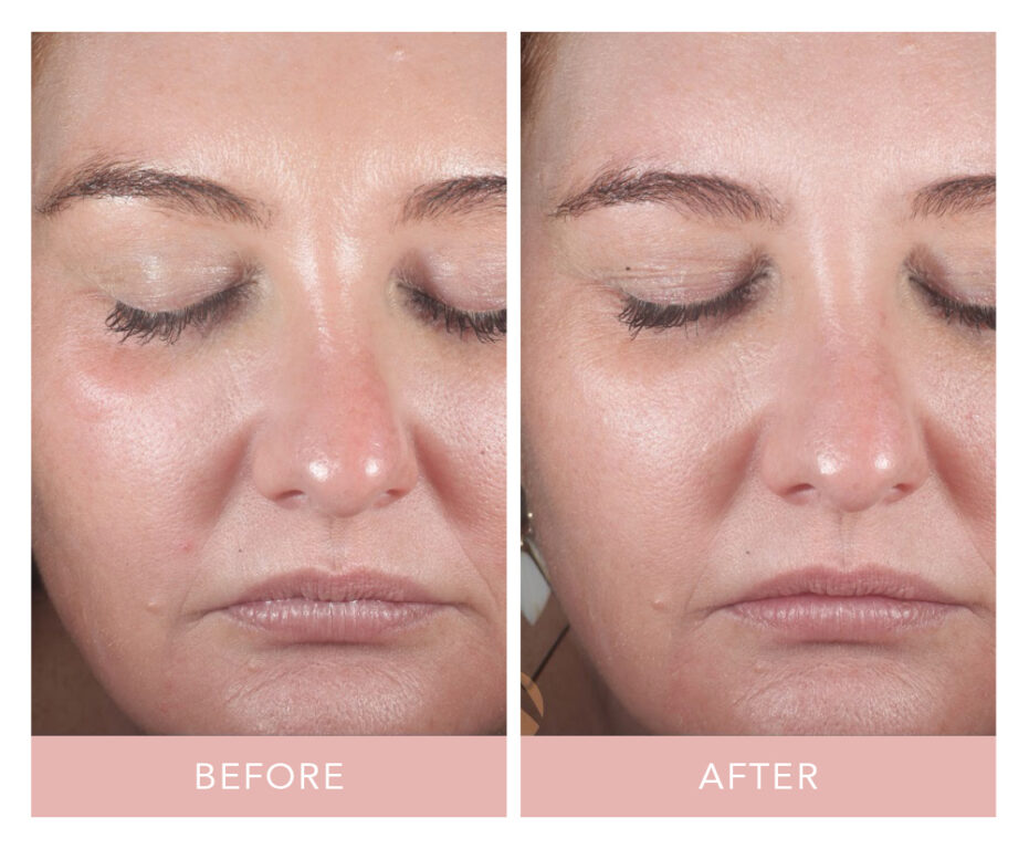 Skinvive by Juvéderm before and after
