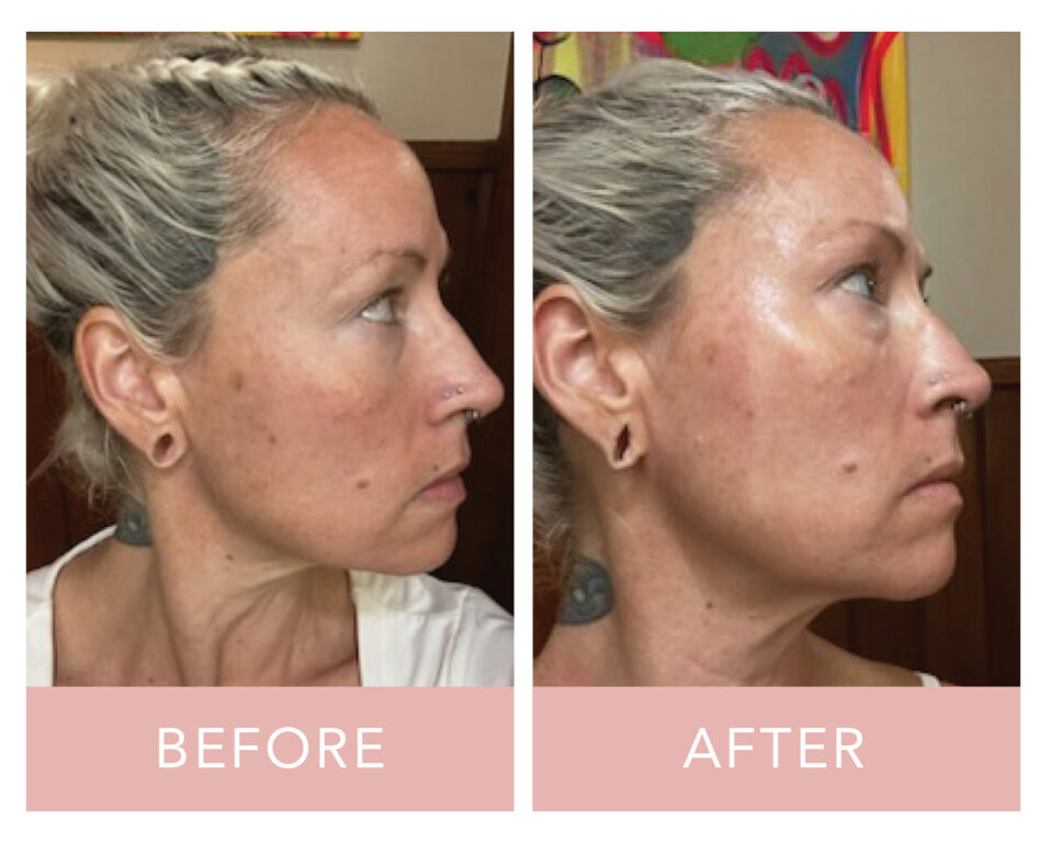 VI Peel before and after