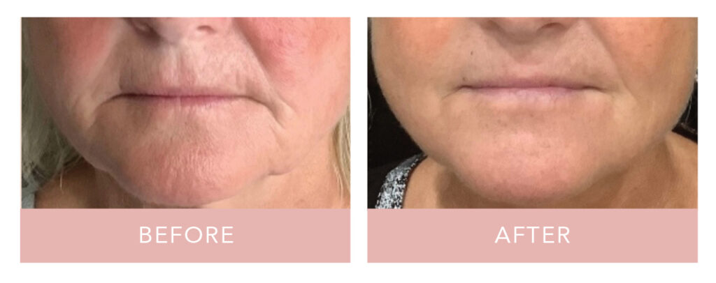 Virtue RF before and after